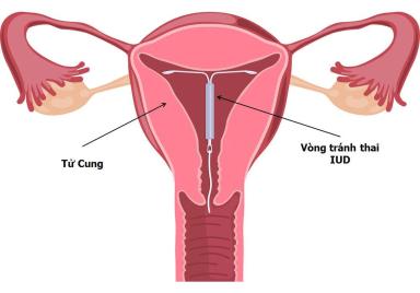 Vòng tránh thai là gì? Hiểu rõ vòng đồng và vòng nội tiết trước khi quyết định đặt