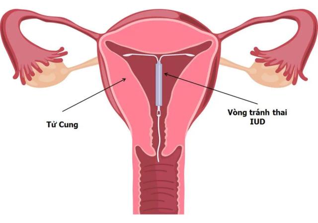 Vòng tránh thai là gì? Hiểu rõ vòng đồng và vòng nội tiết trước khi quyết định đặt