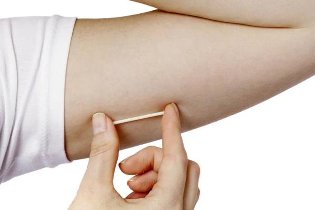 Que cấy tránh thai: hiệu quả, tác dụng phụ và ai nên sử dụng